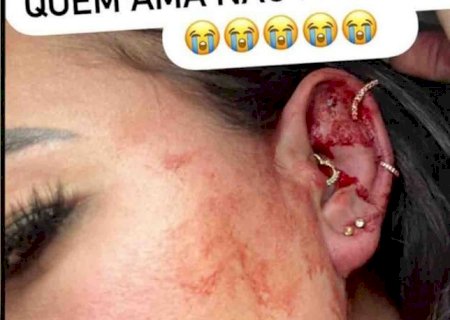 Influencer Milena Lins diz que foi agredida por namorado e posta fotos