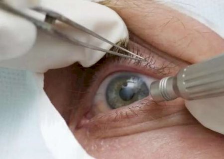 Cirurgia que altera cor do olho tem uso restrito para pessoas cegas