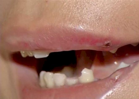 Garota de programa perde dente ao ser agredida por 'cliente' em Campo Grande